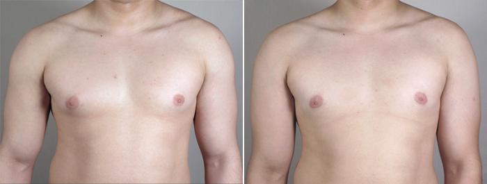 Gynecomastia Surgery Case 638 Before & After View #1 | Paramus, New Jersey | Parker Center for Plastic Surgery