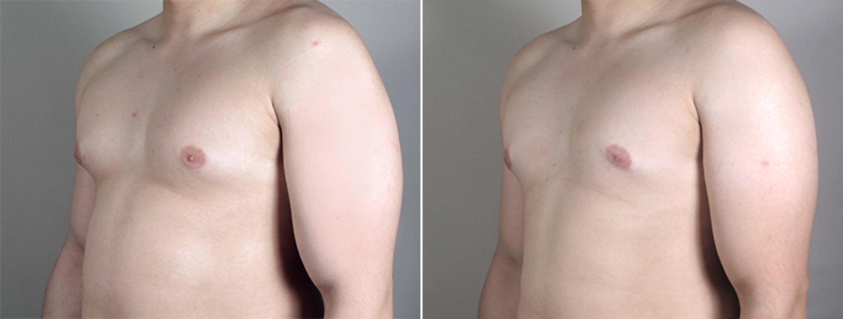 Gynecomastia Surgery Case 638 Before & After View #2 | Paramus, New Jersey | Parker Center for Plastic Surgery