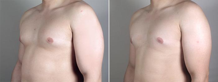 Gynecomastia Surgery Case 638 Before & After View #2 | Paramus, New Jersey | Parker Center for Plastic Surgery