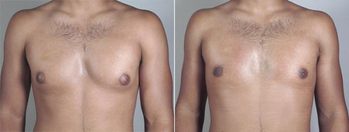 Gynecomastia Surgery Case 639 Before & After View #1 | Paramus, New Jersey | Parker Center for Plastic Surgery