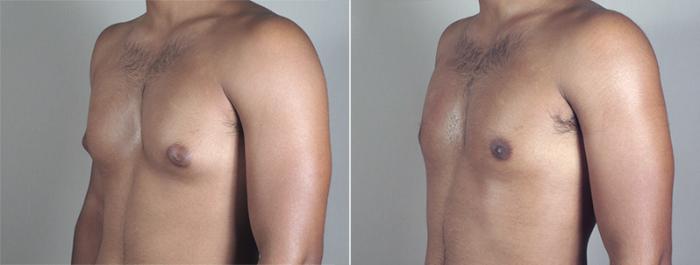 Gynecomastia Surgery Case 639 Before & After View #2 | Paramus, New Jersey | Parker Center for Plastic Surgery