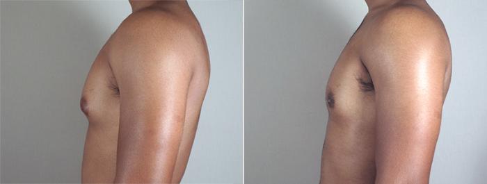 Gynecomastia Surgery Case 639 Before & After View #3 | Paramus, New Jersey | Parker Center for Plastic Surgery