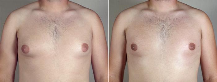 Gynecomastia Surgery Case 640 Before & After View #1 | Paramus, New Jersey | Parker Center for Plastic Surgery