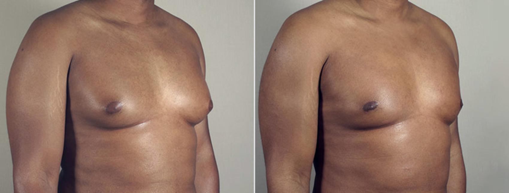 Gynecomastia Surgery Case 642 Before & After View #1 | Paramus, New Jersey | Parker Center for Plastic Surgery