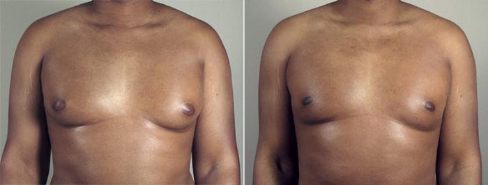 Gynecomastia Surgery Case 642 Before & After View #2 | Paramus, New Jersey | Parker Center for Plastic Surgery