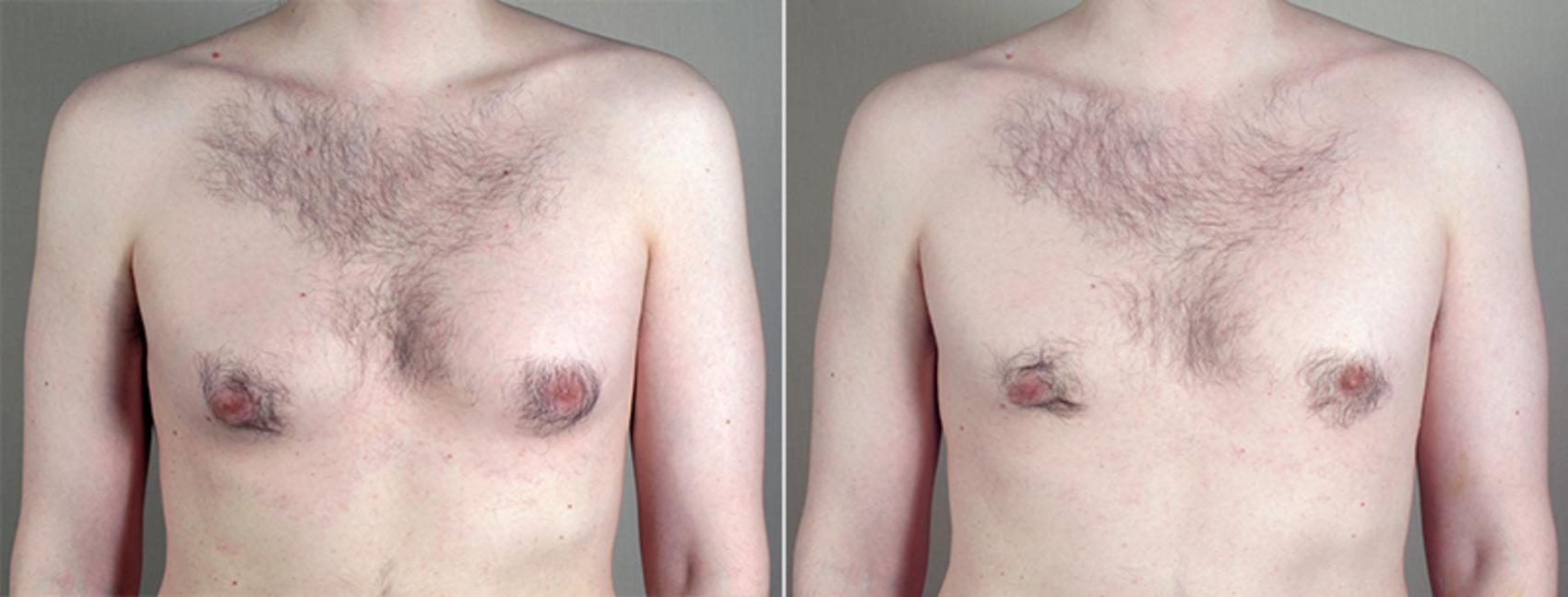 Gynecomastia Surgery Case 643 Before & After View #1 | Paramus, New Jersey | Parker Center for Plastic Surgery