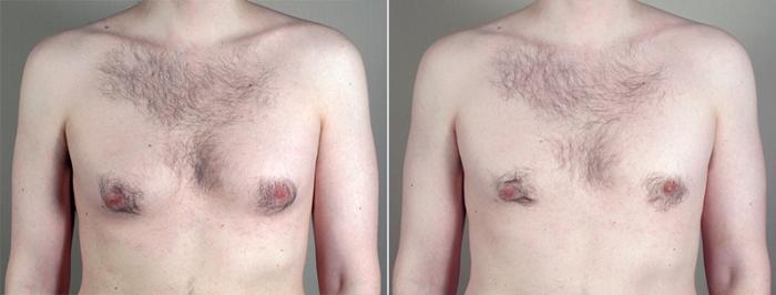 Gynecomastia Surgery Case 643 Before & After View #1 | Paramus, New Jersey | Parker Center for Plastic Surgery