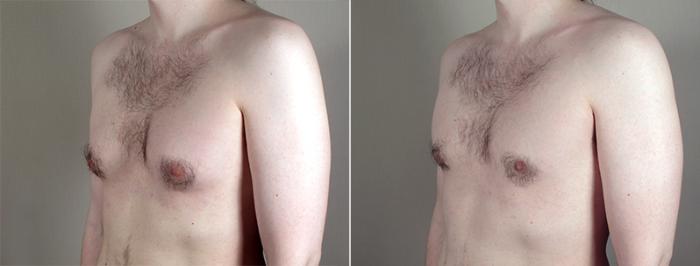 Gynecomastia Surgery Case 643 Before & After View #2 | Paramus, New Jersey | Parker Center for Plastic Surgery