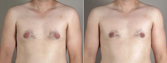 Gynecomastia Surgery Case 644 Before & After View #1 | Paramus, New Jersey | Parker Center for Plastic Surgery