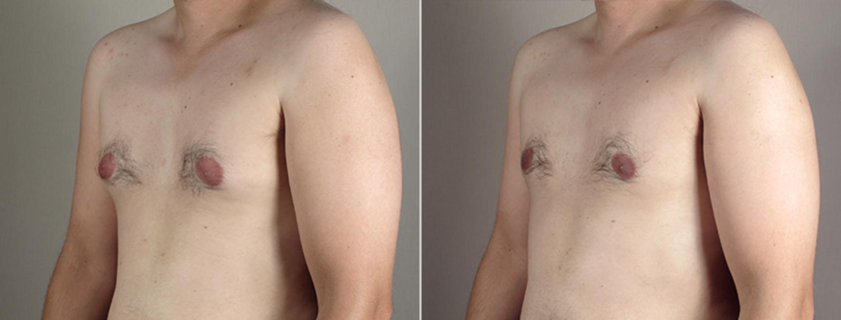 Gynecomastia Surgery Case 644 Before & After View #2 | Paramus, New Jersey | Parker Center for Plastic Surgery