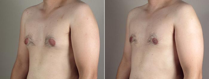 Gynecomastia Surgery Case 644 Before & After View #2 | Paramus, New Jersey | Parker Center for Plastic Surgery