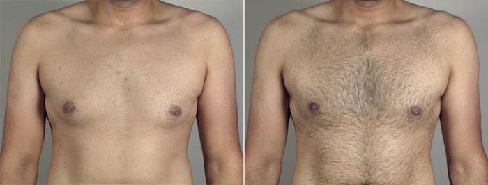 Gynecomastia Surgery Case 645 Before & After View #1 | Paramus, New Jersey | Parker Center for Plastic Surgery