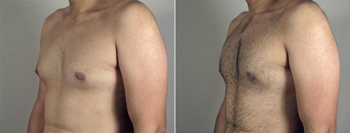 Gynecomastia Surgery Case 645 Before & After View #2 | Paramus, New Jersey | Parker Center for Plastic Surgery