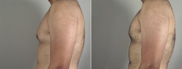Gynecomastia Surgery Case 645 Before & After View #3 | Paramus, New Jersey | Parker Center for Plastic Surgery
