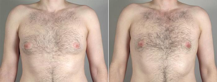 Gynecomastia Surgery Case 646 Before & After View #1 | Paramus, New Jersey | Parker Center for Plastic Surgery