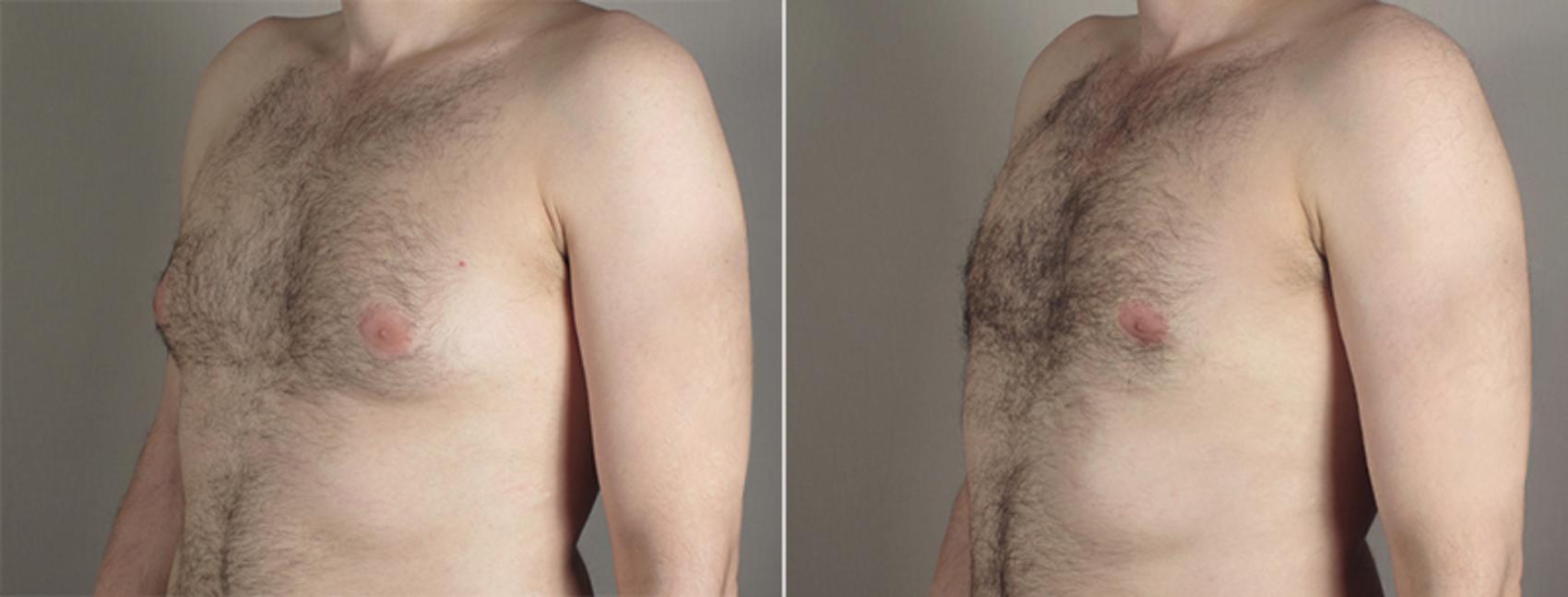 Gynecomastia Surgery Case 646 Before & After View #2 | Paramus, New Jersey | Parker Center for Plastic Surgery