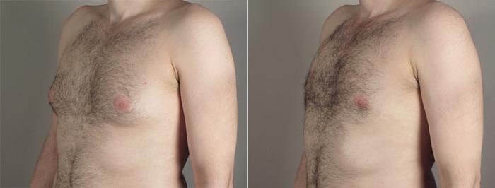 Gynecomastia Surgery Case 646 Before & After View #2 | Paramus, New Jersey | Parker Center for Plastic Surgery