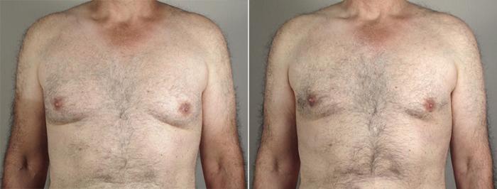 Gynecomastia Surgery Case 647 Before & After View #1 | Paramus, New Jersey | Parker Center for Plastic Surgery
