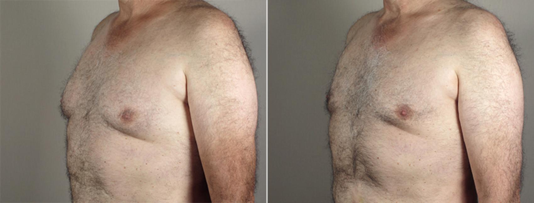 Gynecomastia Surgery Case 647 Before & After View #2 | Paramus, New Jersey | Parker Center for Plastic Surgery