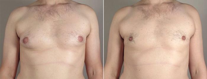 Gynecomastia Surgery Case 648 Before & After View #1 | Paramus, New Jersey | Parker Center for Plastic Surgery