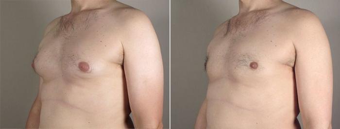 Gynecomastia Surgery Case 648 Before & After View #2 | Paramus, New Jersey | Parker Center for Plastic Surgery