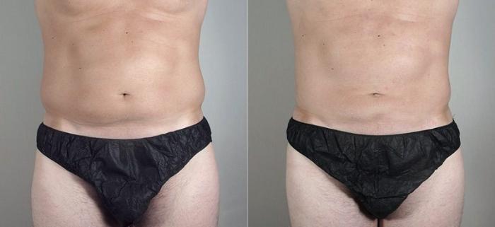 Gynecomastia Surgery Case 649 Before & After View #1 | Paramus, New Jersey | Parker Center for Plastic Surgery