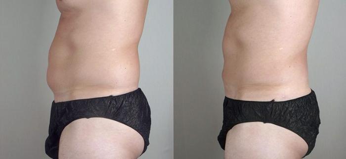 Gynecomastia Surgery Case 649 Before & After View #2 | Paramus, New Jersey | Parker Center for Plastic Surgery