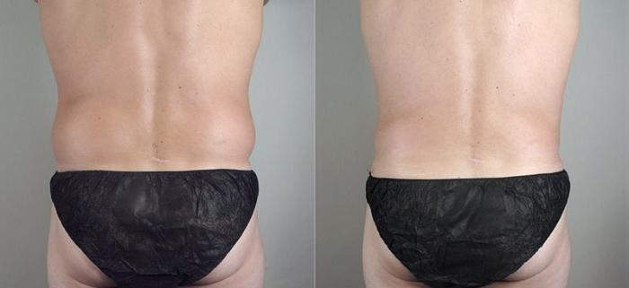 Gynecomastia Surgery Case 649 Before & After View #3 | Paramus, New Jersey | Parker Center for Plastic Surgery