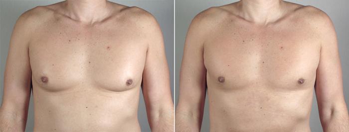 Gynecomastia Surgery Case 649 Before & After View #4 | Paramus, New Jersey | Parker Center for Plastic Surgery
