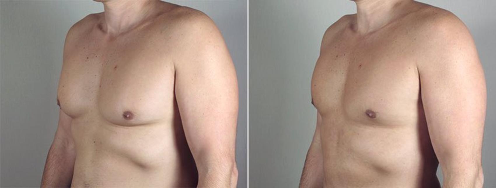 Gynecomastia Surgery Case 649 Before & After View #5 | Paramus, New Jersey | Parker Center for Plastic Surgery