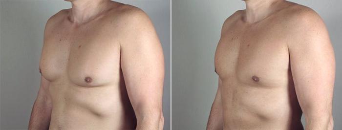 Gynecomastia Surgery Case 649 Before & After View #5 | Paramus, New Jersey | Parker Center for Plastic Surgery
