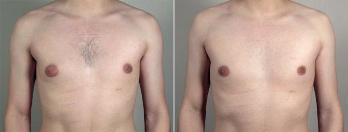 Gynecomastia Surgery Case 650 Before & After View #1 | Paramus, New Jersey | Parker Center for Plastic Surgery