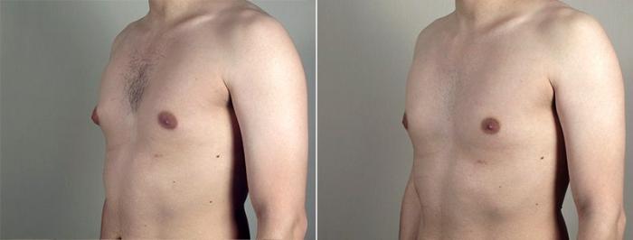 Gynecomastia Surgery Case 650 Before & After View #2 | Paramus, New Jersey | Parker Center for Plastic Surgery