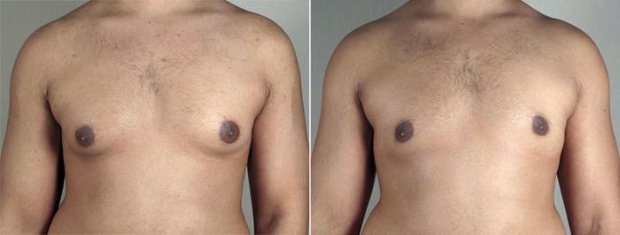 Gynecomastia Surgery Case 651 Before & After View #1 | Paramus, New Jersey | Parker Center for Plastic Surgery