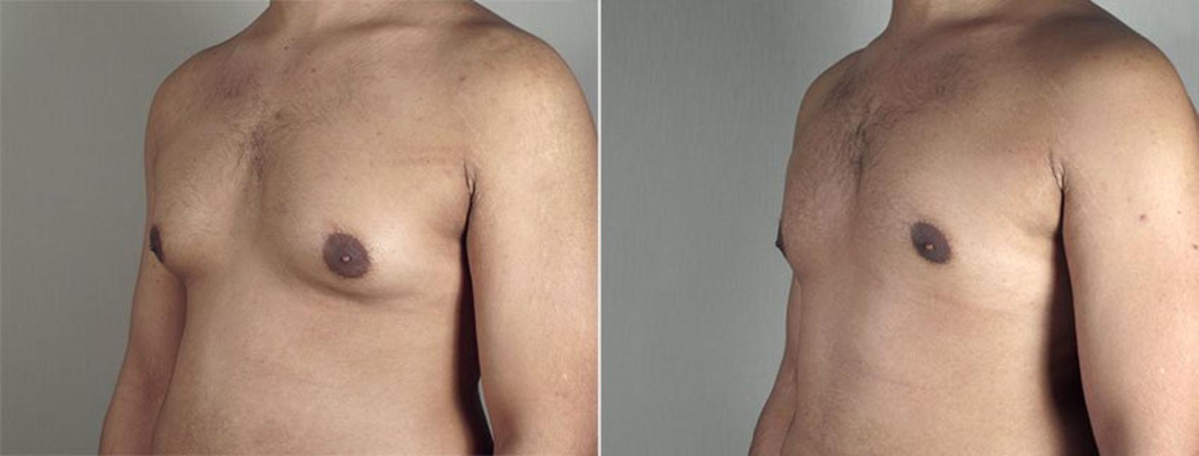 Gynecomastia Surgery Case 651 Before & After View #2 | Paramus, New Jersey | Parker Center for Plastic Surgery