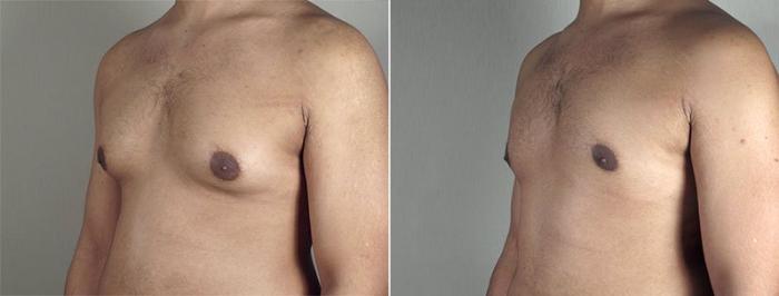 Gynecomastia Surgery Case 651 Before & After View #2 | Paramus, New Jersey | Parker Center for Plastic Surgery