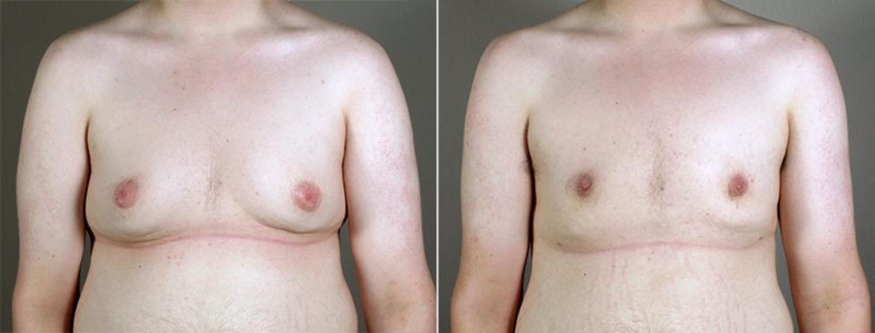 Gynecomastia Surgery Case 652 Before & After View #1 | Paramus, New Jersey | Parker Center for Plastic Surgery