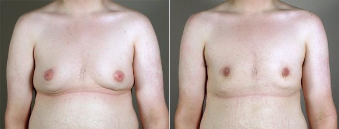 Gynecomastia Surgery Case 652 Before & After View #1 | Paramus, New Jersey | Parker Center for Plastic Surgery