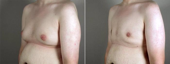 Gynecomastia Surgery Case 652 Before & After View #2 | Paramus, New Jersey | Parker Center for Plastic Surgery