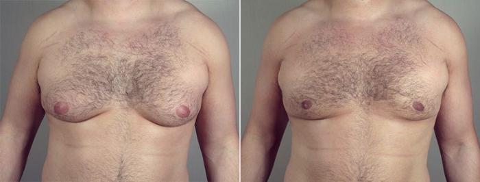 Gynecomastia Surgery Case 653 Before & After View #1 | Paramus, New Jersey | Parker Center for Plastic Surgery