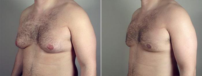 Gynecomastia Surgery Case 653 Before & After View #2 | Paramus, New Jersey | Parker Center for Plastic Surgery
