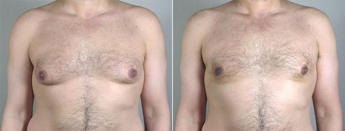 Gynecomastia Surgery Case 654 Before & After View #1 | Paramus, New Jersey | Parker Center for Plastic Surgery
