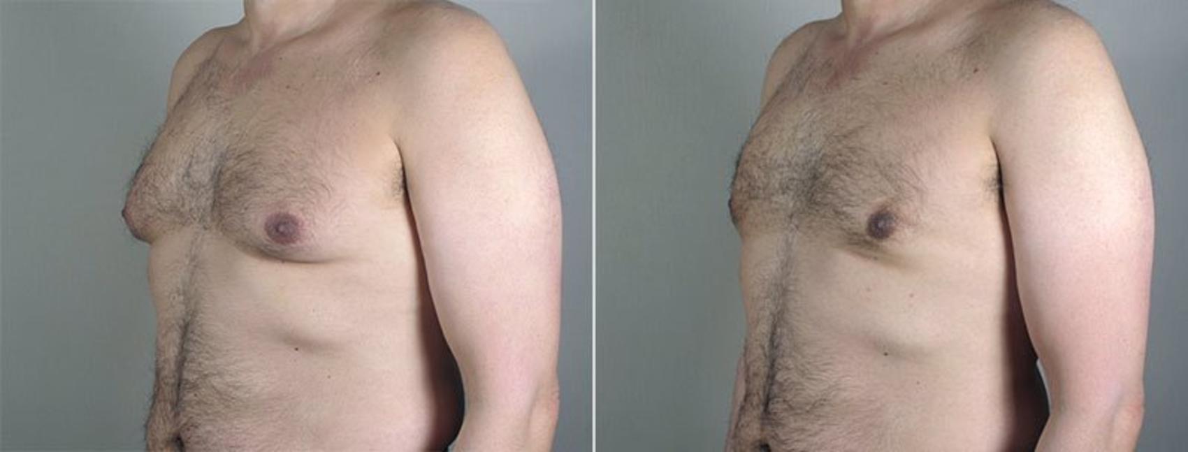 Gynecomastia Surgery Case 654 Before & After View #2 | Paramus, New Jersey | Parker Center for Plastic Surgery