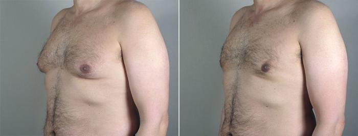 Gynecomastia Surgery Case 654 Before & After View #2 | Paramus, New Jersey | Parker Center for Plastic Surgery