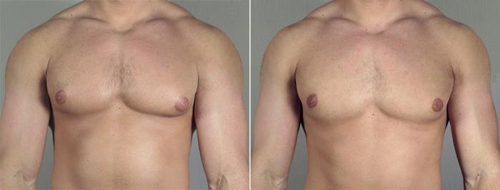 Gynecomastia Surgery Case 655 Before & After View #1 | Paramus, New Jersey | Parker Center for Plastic Surgery