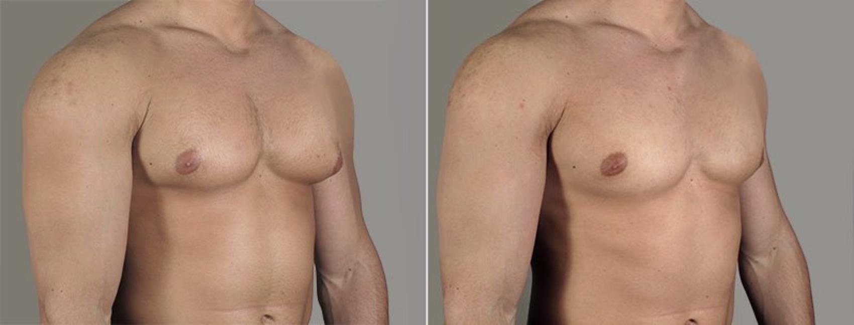 Gynecomastia Surgery Case 655 Before & After View #2 | Paramus, New Jersey | Parker Center for Plastic Surgery