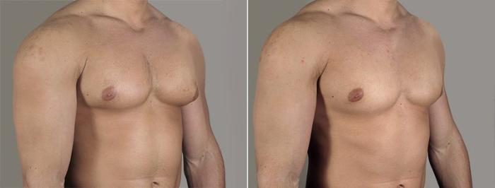 Gynecomastia Surgery Case 655 Before & After View #2 | Paramus, New Jersey | Parker Center for Plastic Surgery
