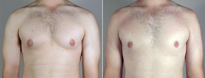 Gynecomastia Surgery Case 656 Before & After View #1 | Paramus, New Jersey | Parker Center for Plastic Surgery