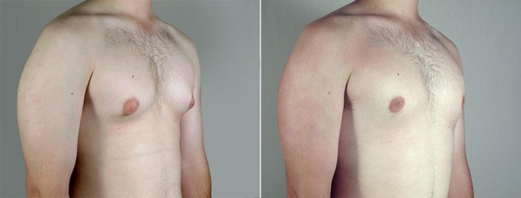 Gynecomastia Surgery Case 656 Before & After View #2 | Paramus, New Jersey | Parker Center for Plastic Surgery
