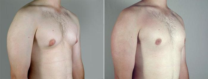 Gynecomastia Surgery Case 656 Before & After View #2 | Paramus, New Jersey | Parker Center for Plastic Surgery